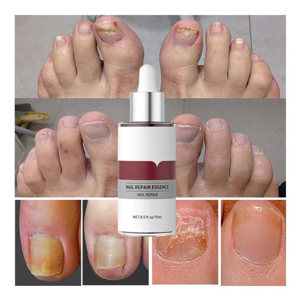 Fungus-Free Nail Revitalizer
