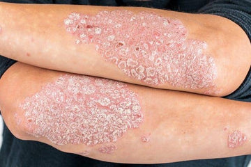 12 home remedies for relieve psoriasis