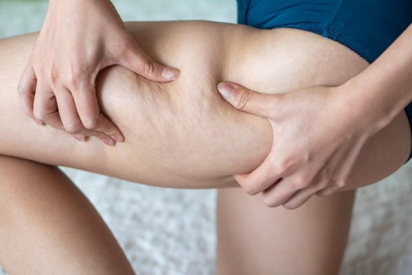 Everything you need to know about cellulite