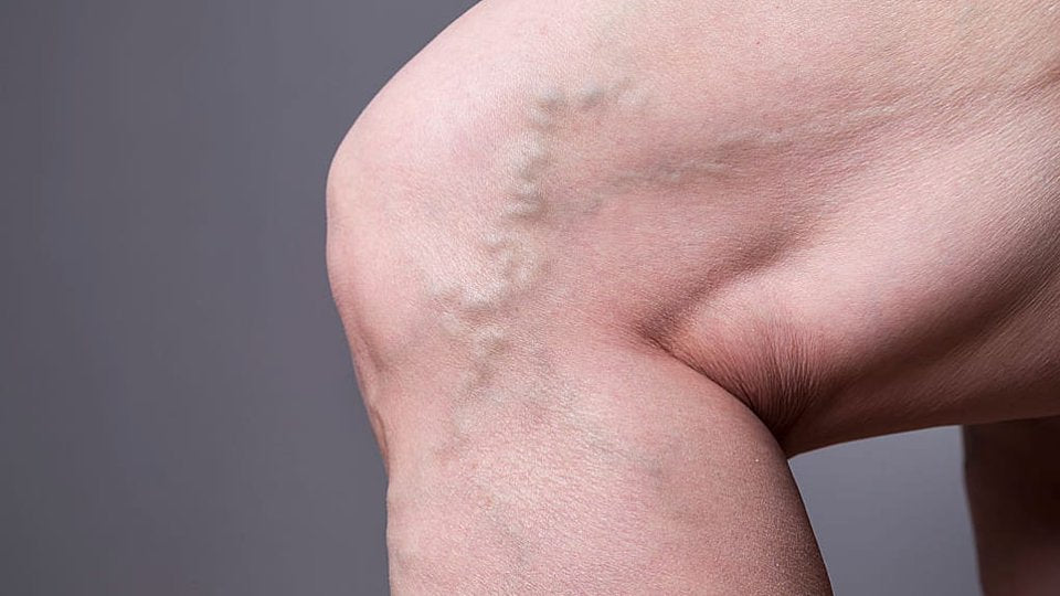 Say Goodbye to Varicose Veins with These Top 5 Solutions