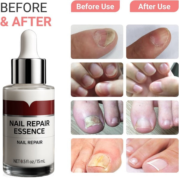 fight nail fungus with Nail Repair  Essence
