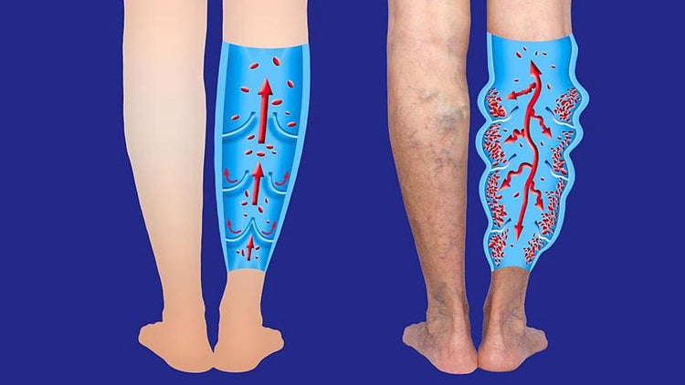 before and after Varicose Veins Relief Cream